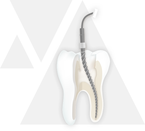 endodontie step 3